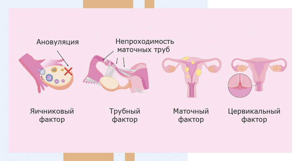 Овуляция есть, а беременность не наступает причины