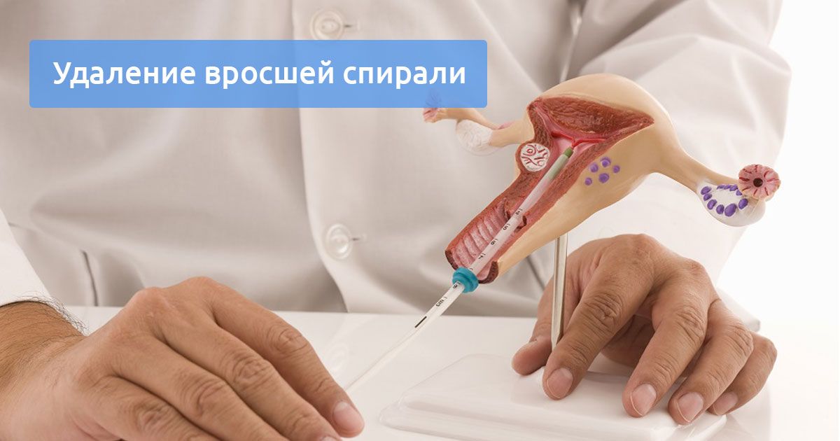 Удаление вросшей внутриматочной спирали